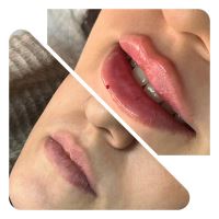 بوتاکس در اکباتان