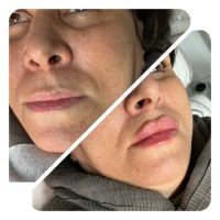 بوتاکس در اکباتان