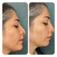 بوتاکس در اکباتان