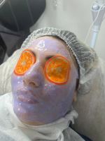 فیلر لب در اکباتان