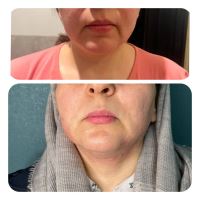 فیلر لب در اکباتان