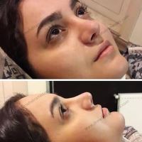 دکتر عمل بینی در مازندران