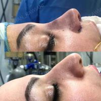 دکتر عمل بینی در مازندران