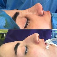 دکتر عمل بینی در مازندران