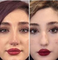 دکتر عمل بینی در مازندران