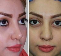 دکتر عمل بینی در مازندران