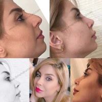 دکتر عمل بینی در مازندران