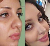 دکتر عمل بینی در مازندران