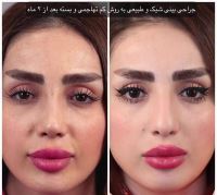 دکتر عمل بینی در مازندران