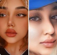 دکتر عمل بینی در تبریز