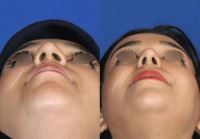 دکتر عمل بینی در تبریز