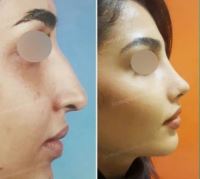 دکتر عمل بینی در تبریز