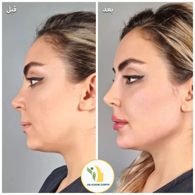 تزریق ژل گونه در بهارستان