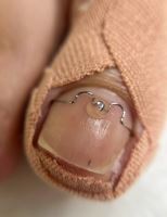 پودولوژی در اصفهان