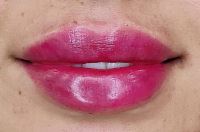 بهترین کلینیک تزریق ژل در قائمشهر