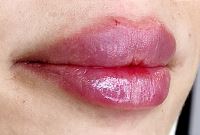 بهترین کلینیک تزریق ژل در قائمشهر