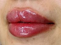 بهترین کلینیک تزریق ژل در قائمشهر