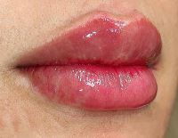 بهترین کلینیک تزریق ژل در قائمشهر