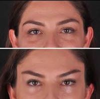 لیفت شقیقه چشم گربه ای با نخ در قائمشهر