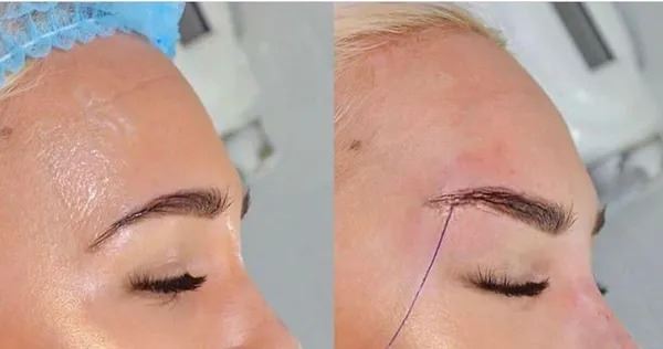 لیفت شقیقه چشم گربه ای با نخ در قائمشهر