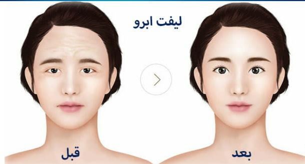 بهترین کلینیک لیفت ابرو با نخ در قائمشهر