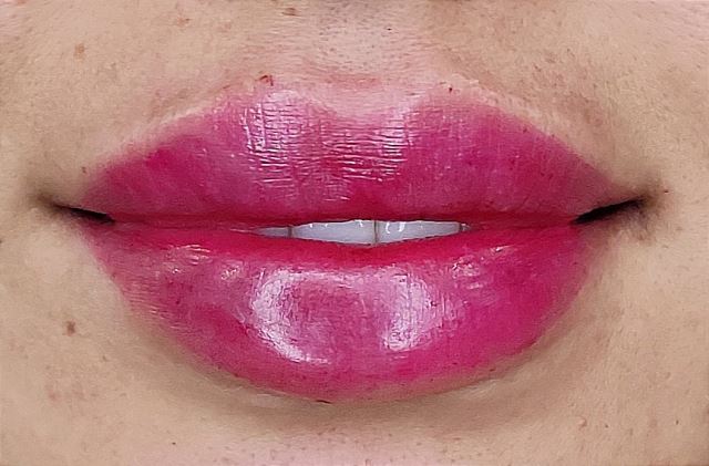 تزریق ژل لب روسی در قائمشهر 