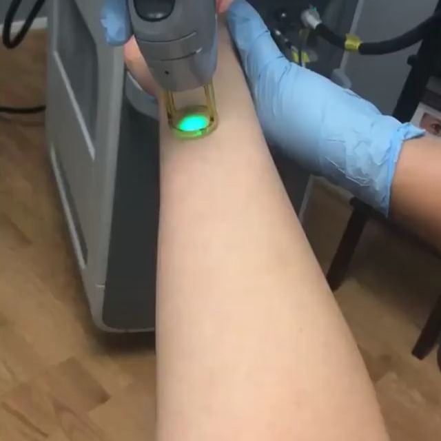 لیزر موهای زائد در قائمشهر