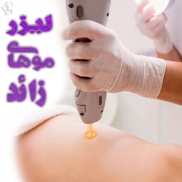 لیزر موهای زائد در قائمشهر