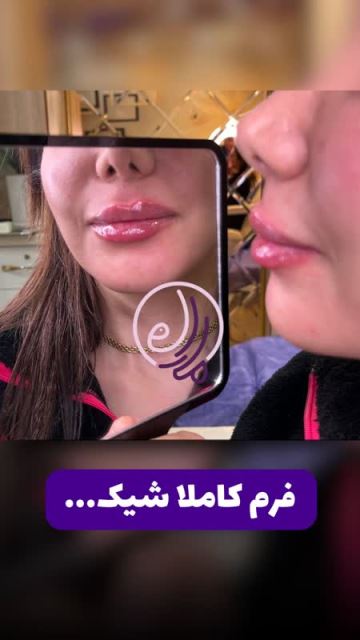 بلفاروپلاستی در شهرک گلستان