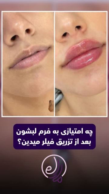 بهترین بلفاروپلاستی در شهرک گلستان