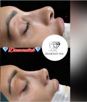 عمل بینی استخوانی در ولیعصر