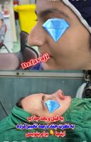 عمل بینی استخوانی در ولیعصر