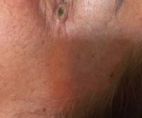 درمان زگیل در شاهین شهر