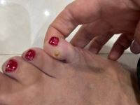 درمان زگیل با لیزر در شاهین شهر