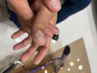 درمان میخچه در شاهین شهر