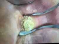 درمان زگیل در شاهین شهر