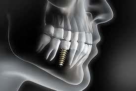 ایمپلنت دندان یزد