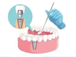 ایمپلنت دندان یزد