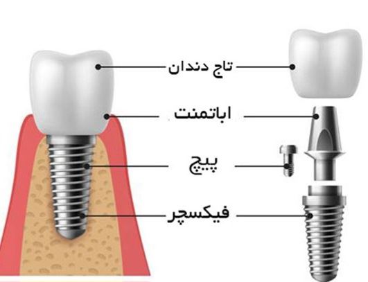 ایمپلنت دندان یزد