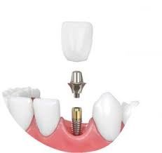ایمپلنت دندان یزد