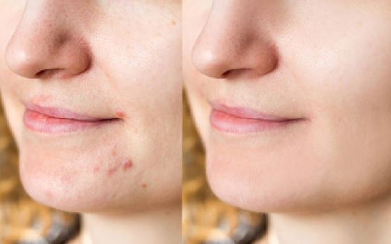 بهترین مرکز فیشیال و پاکسازی پوست در تهران 