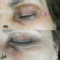 رفع سیاهی و چین و چروک دور چشم در شیراز
