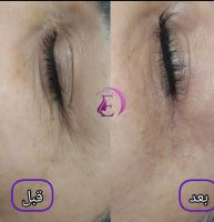 رفع سیاهی و چین و چروک دور چشم در شیراز