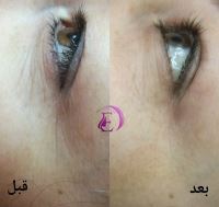 رفع سیاهی و چین و چروک دور چشم در شیراز