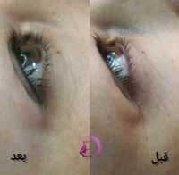 رفع سیاهی و چین و چروک دور چشم در شیراز