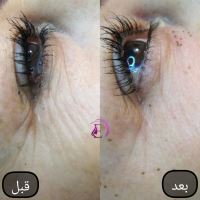 رفع سیاهی و چین و چروک دور چشم در شیراز