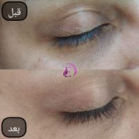 رفع سیاهی و چین و چروک دور چشم در شیراز