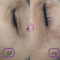 رفع سیاهی و چین و چروک دور چشم در شیراز