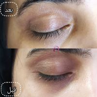 رفع سیاهی و چین و چروک دور چشم در شیراز