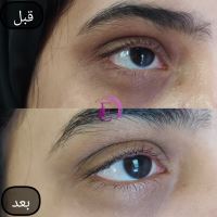 رفع سیاهی و چین و چروک دور چشم در شیراز